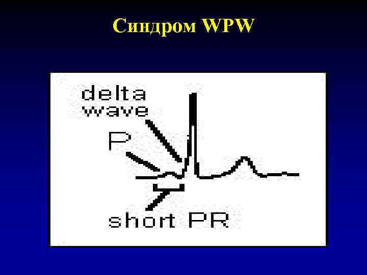 Синдром WPW 
