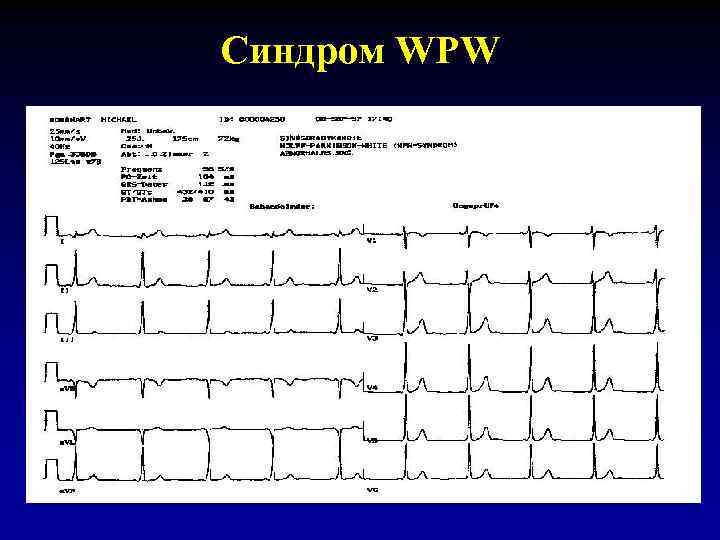 Синдром WPW 
