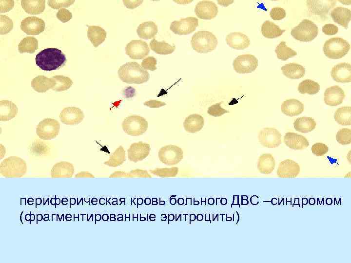 периферическая кровь больного ДВС –синдромом (фрагментированные эритроциты) 