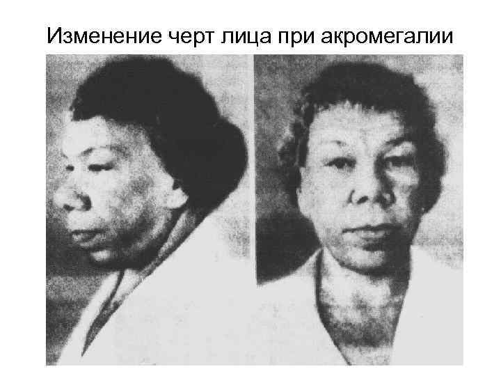 Изменение черт лица при акромегалии 