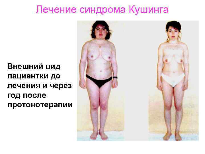 Лечение синдрома Кушинга Внешний вид пациентки до лечения и через год после протонотерапии 