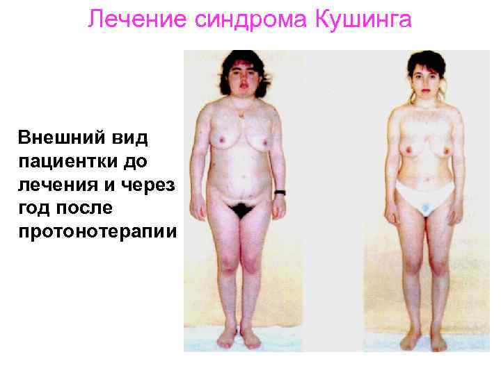 Лечение синдрома Кушинга Внешний вид пациентки до лечения и через год после протонотерапии 