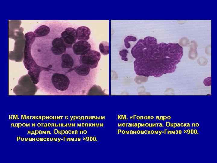 КМ. Мегакариоцит с уродливым ядром и отдельными мелкими ядрами. Окраска по Романовскому-Гимзе × 900.