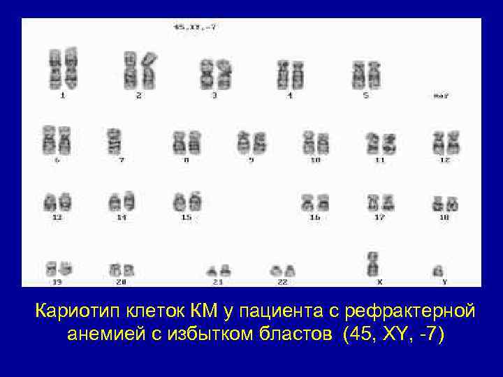 Кариотип 45. Кариотип 45xy. Кариотип 45 ху. Кариотип 45 ху 13-. Лейкемия кариотип.