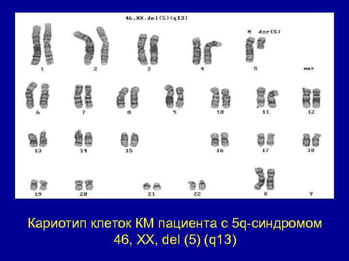 Кариотип клеток КМ пациента с 5 q-синдромом 46, XX, del (5) (q 13) 