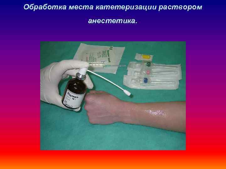 Обработка места катетеризации раствором анестетика. 