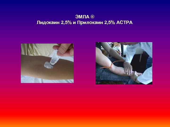 ЭMЛА ® Лидокаин 2, 5% и Прилокаин 2, 5% АСТРА 