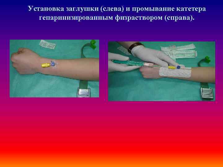 Установка заглушки (слева) и промывание катетера гепаринизированным физраствором (справа). 