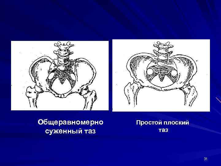 Общеравномерно суженный таз Простой плоский таз 31 