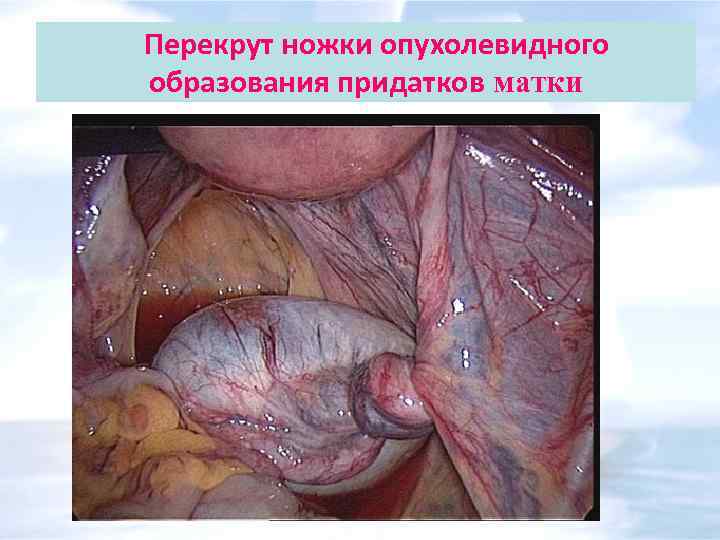 Перекрут ножки опухолевидного образования придатков матки 