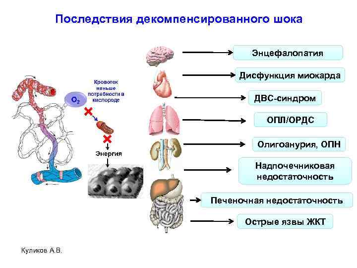 Последствия декомпенсированного шока Энцефалопатия Дисфункция миокарда ДВС-синдром ОПЛ/ОРДС Олигоанурия, ОПН Надпочечниковая недостаточность Печеночная недостаточность