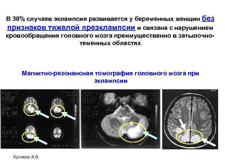 В 30% случаев эклампсия развивается у беременных женщин без признаков тяжелой преэклампсии и связана