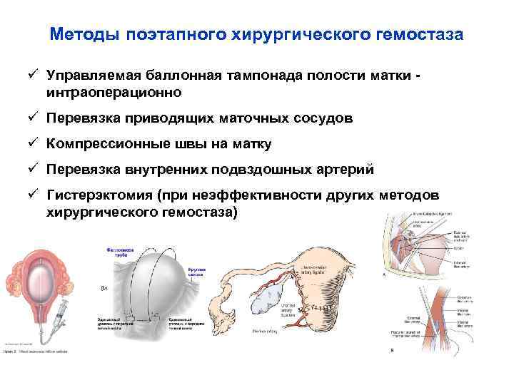 Методы поэтапного хирургического гемостаза ü Управляемая баллонная тампонада полости матки - интраоперационно ü Перевязка