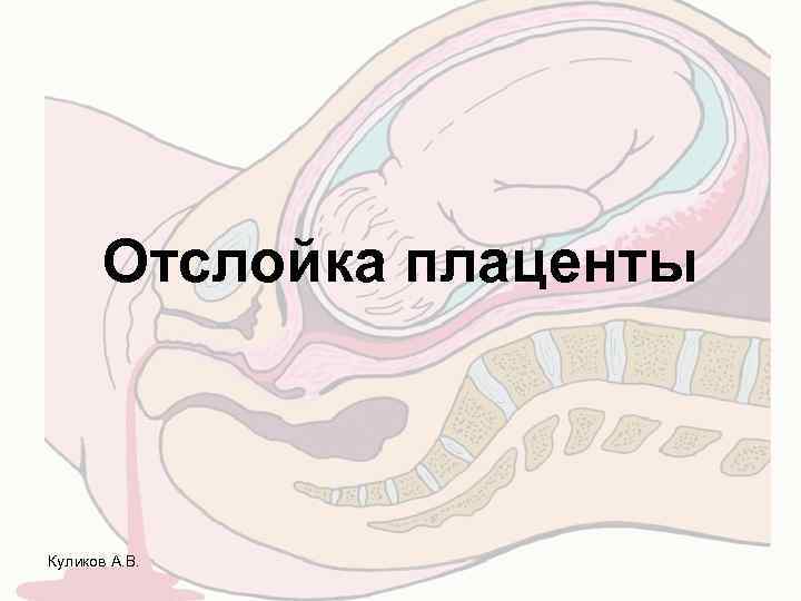 Отслойка плаценты Куликов А. В. 