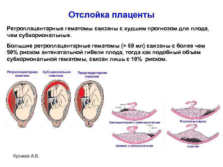 Отслойка плаценты Ретроплацентарные гематомы связаны с худшим прогнозом для плода, чем субхориональные. Большие ретроплацентарные