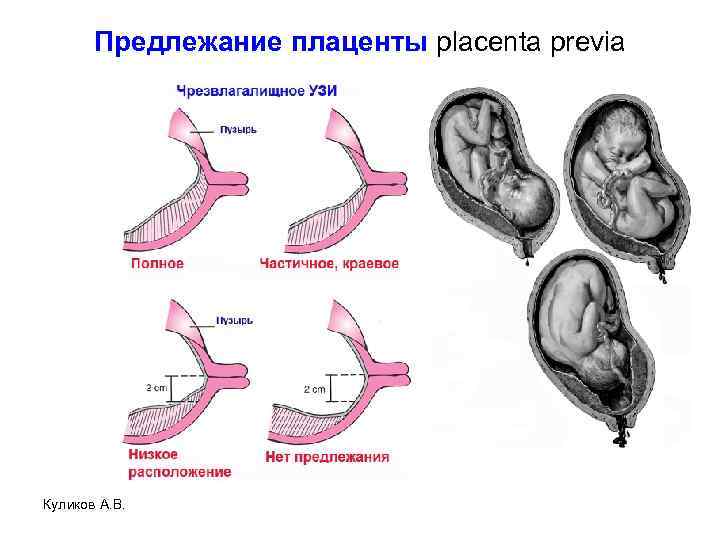 Предлежание плаценты при беременности