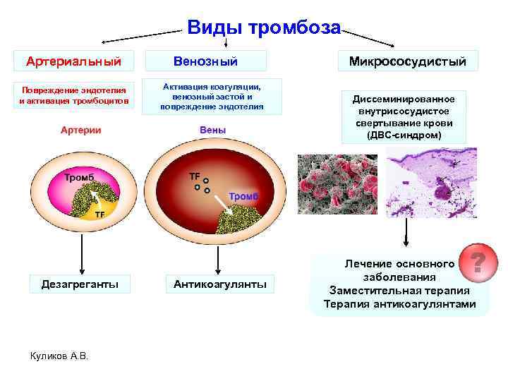 Виды тромбоза Артериальный Повреждение эндотелия и активация тромбоцитов Дезагреганты Куликов А. В. Венозный Активация