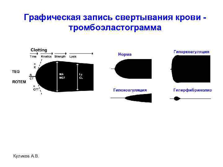 Графическая запись свертывания крови - тромбоэластограмма Куликов А. В. 