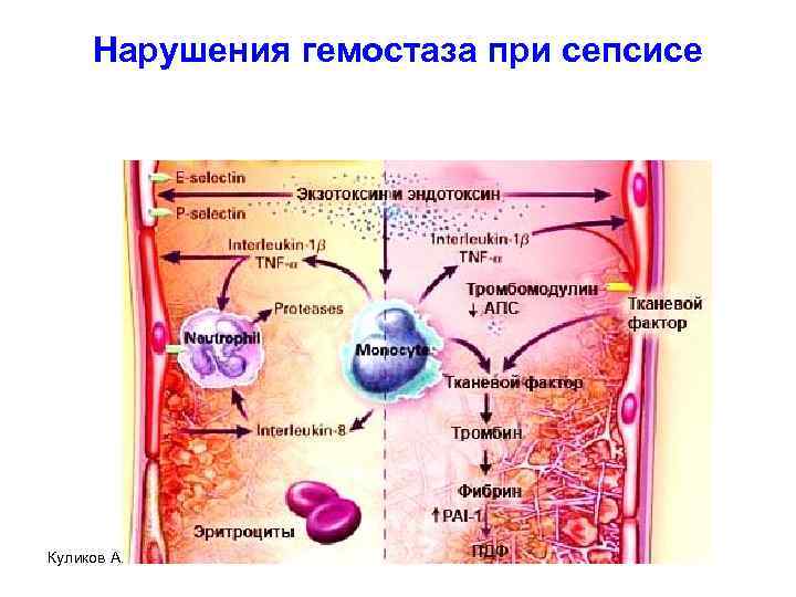 Нарушения гемостаза при сепсисе Куликов А. В. 