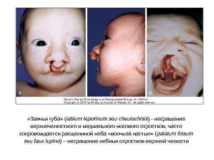  «Заячья губа» (labium leporinum seu cheulochisis) - несращение верхнечелюстного и медиального носового отростков,
