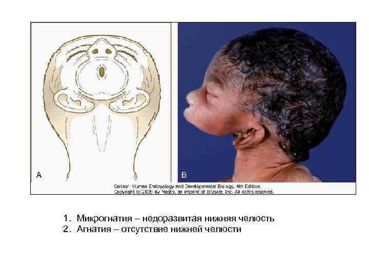 1. Микрогнатия – недоразвитая нижняя челюсть 2. Агнатия – отсутствие нижней челюсти 