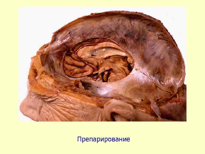 Препарирование 