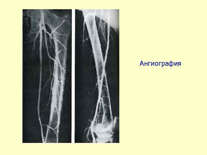 Ангиография 