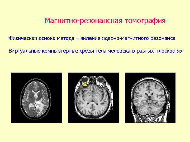 Магнитно-резонансная томография Физическая основа метода – явление ядерно-магнитного резонанса Виртуальные компьютерные срезы тела человека