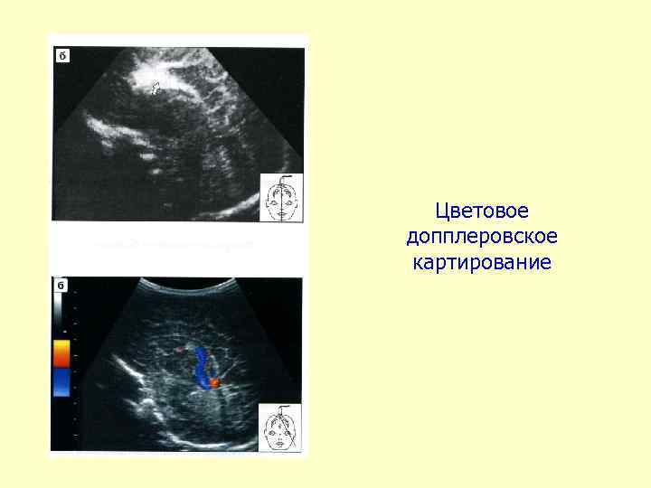 Цветовое допплеровское картирование 