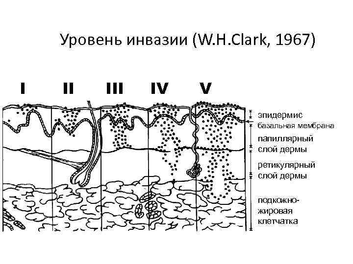 Уровень инвазии (W. H. Clark, 1967) I II IV V эпидермис базальная мембрана папиллярный