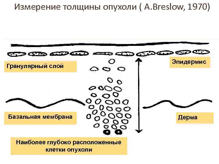 Измерение толщины опухоли ( A. Breslow, 1970) Гранулярный слой Базальная мембрана Наиболее глубоко расположенные