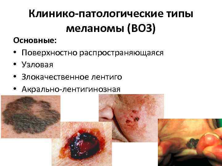 Клинико-патологические типы меланомы (ВОЗ) Основные: • Поверхностно распространяющаяся • Узловая • Злокачественное лентиго •