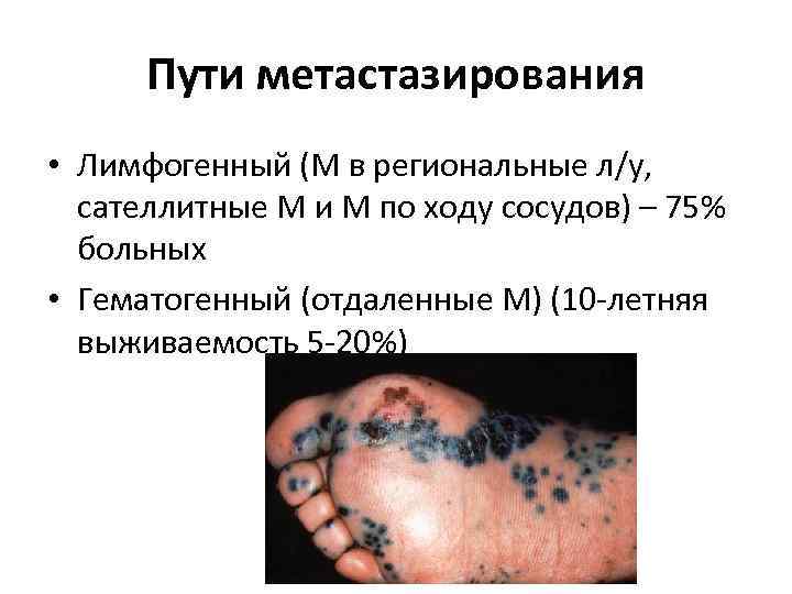 Пути метастазирования • Лимфогенный (М в региональные л/у, сателлитные М и М по ходу