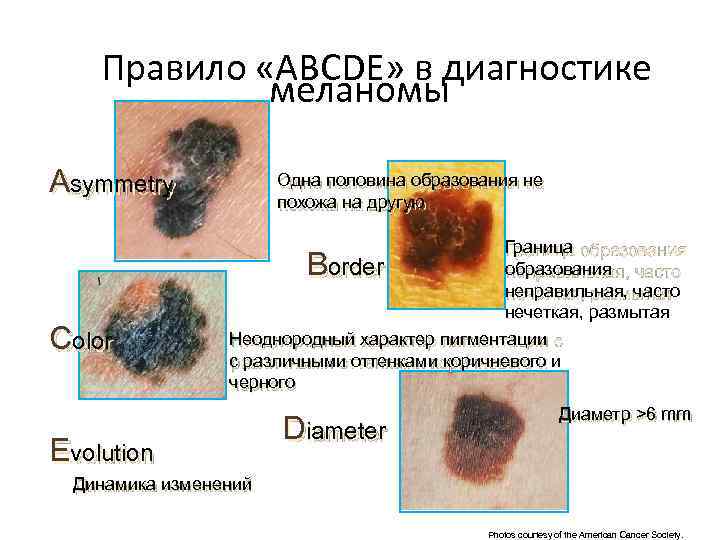 Правило «ABCDE» в диагностике меланомы Asymmetry Одна половина образования не похожа на другую Граница