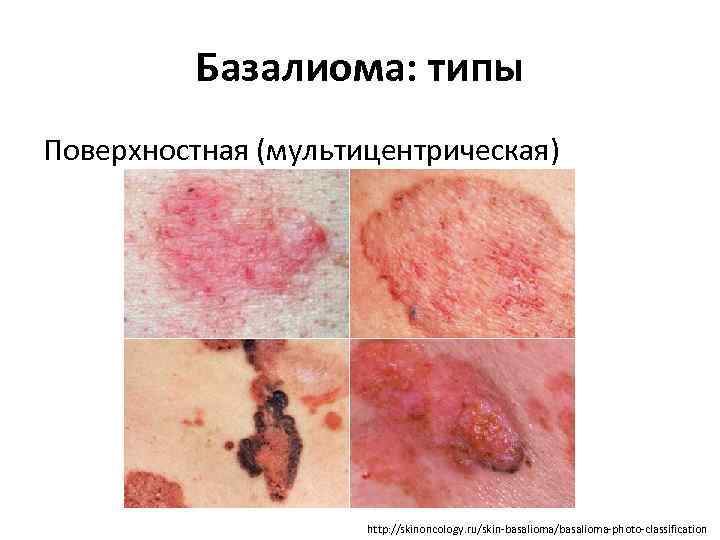 Базалиома: типы Поверхностная (мультицентрическая) http: //skinoncology. ru/skin-basalioma/basalioma-photo-classification 