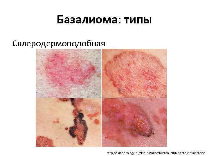 Базалиома: типы Склеродермоподобная http: //skinoncology. ru/skin-basalioma/basalioma-photo-classification 