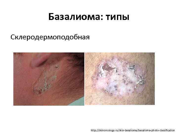 Базалиома: типы Склеродермоподобная http: //skinoncology. ru/skin-basalioma/basalioma-photo-classification 