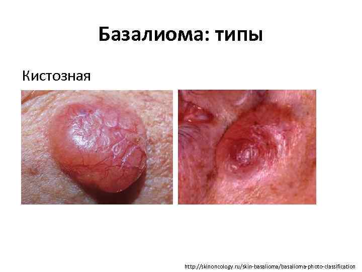 Базалиома: типы Кистозная http: //skinoncology. ru/skin-basalioma/basalioma-photo-classification 