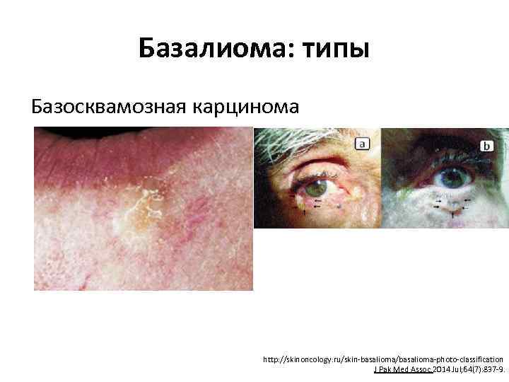 Базалиома: типы Базосквамозная карцинома http: //skinoncology. ru/skin-basalioma/basalioma-photo-classification J Pak Med Assoc. 2014 Jul; 64(7):