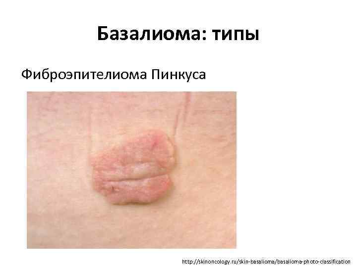 Базалиома: типы Фиброэпителиома Пинкуса http: //skinoncology. ru/skin-basalioma/basalioma-photo-classification 