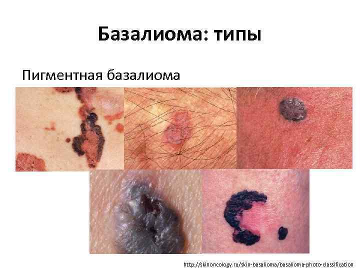 Базалиома: типы Пигментная базалиома http: //skinoncology. ru/skin-basalioma/basalioma-photo-classification 