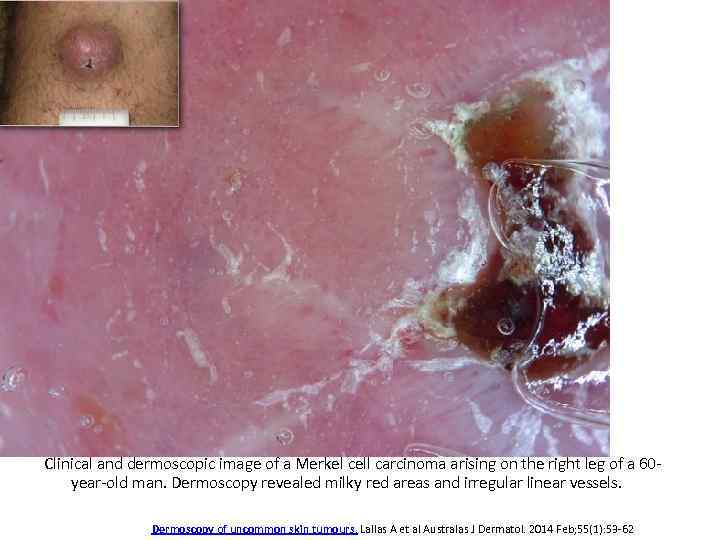 Clinical and dermoscopic image of a Merkel cell carcinoma arising on the right leg