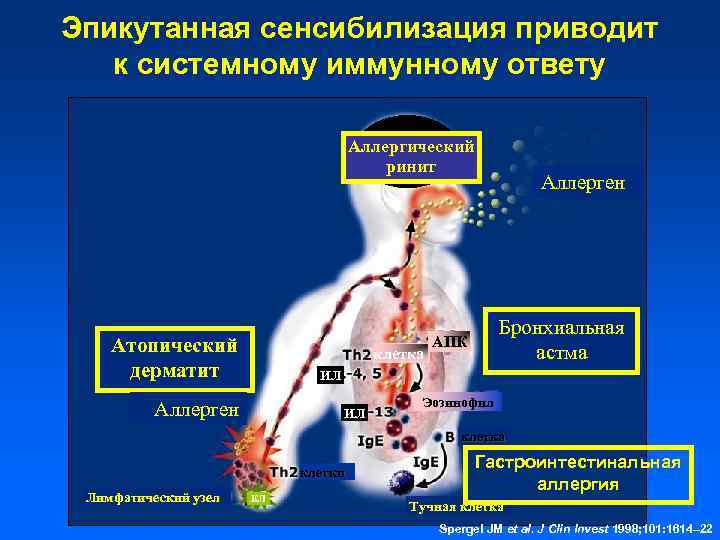 Эпикутанная сенсибилизация приводит к системному иммунному ответу Аллергический ринит Атопический дерматит клетка Аллерген Бронхиальная