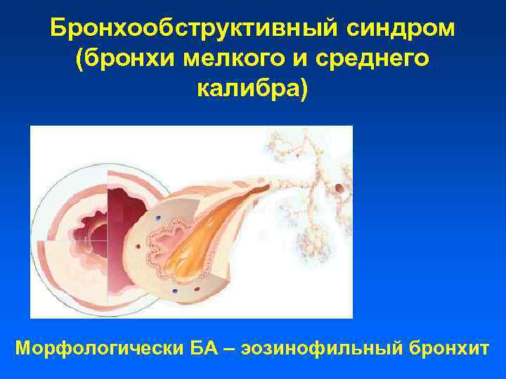 Бронхообструктивный синдром (бронхи мелкого и среднего калибра) Морфологически БА – эозинофильный бронхит 