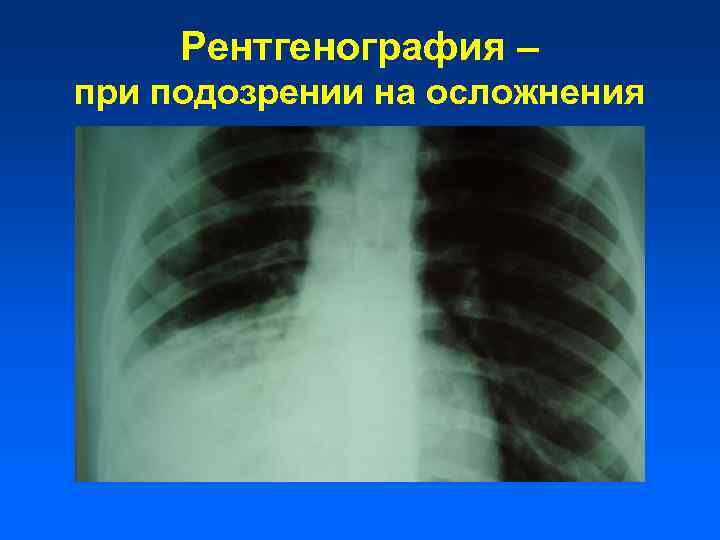 Рентгенография – при подозрении на осложнения 