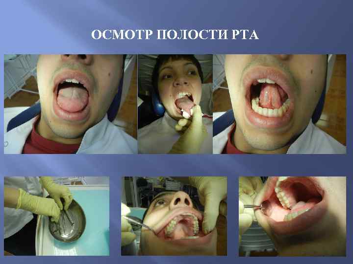 ОСМОТР ПОЛОСТИ РТА 