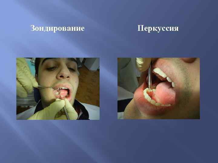 Зондирование Перкуссия 