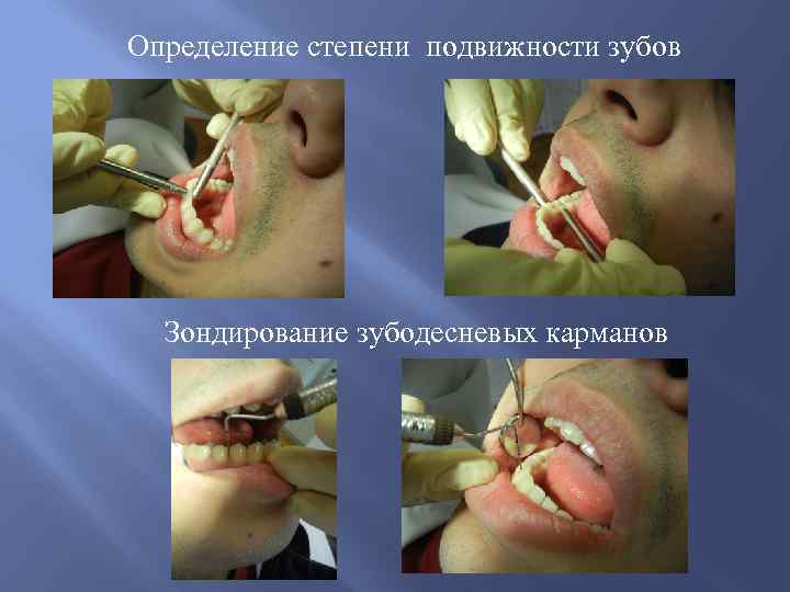 Определение степени подвижности зубов Зондирование зубодесневых карманов 