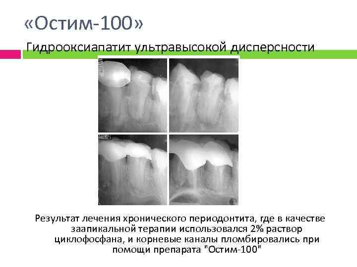  «Остим-100» Гидрооксиапатит ультравысокой дисперсности Результат лечения хронического периодонтита, где в качестве заапикальной терапии