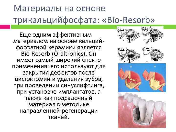 Материалы на основе трикальцийфосфата: «Bio-Resorb» Еще одним эффективным материалом на основе кальцийфосфатной керамики является